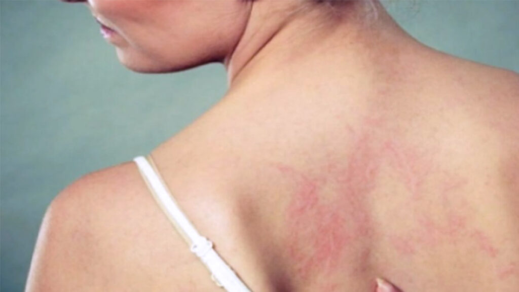 La Lepra en México avanza en 18 estados